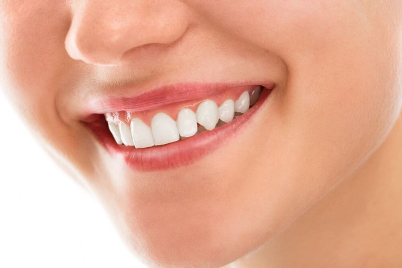 sonrisa tras un blanqueamiento dental